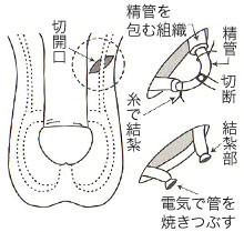 パイプ カット 射精